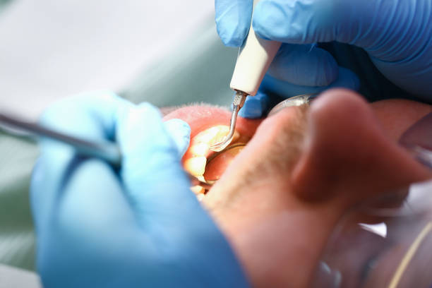 Best Emergency Tooth Extraction in Oakwood, PA